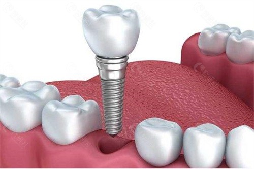 松鼠口腔医院种植牙价格表