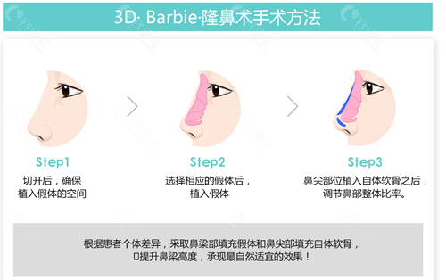 韩国珠儿丽整形外科做鼻子好吗