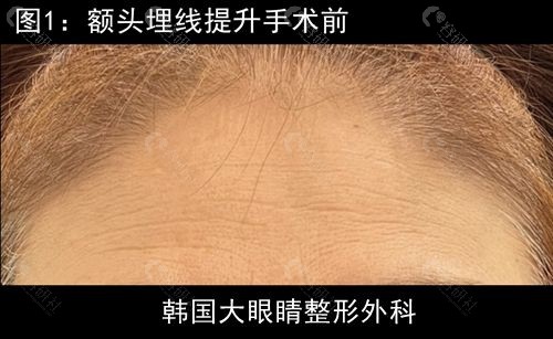 韩国大眼睛整形外科额头埋线提升手术前