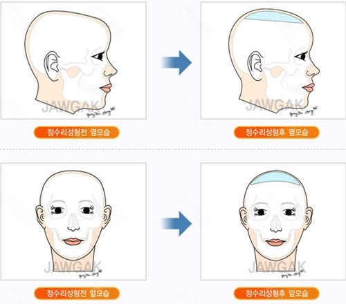 后脑勺填充前后对比照