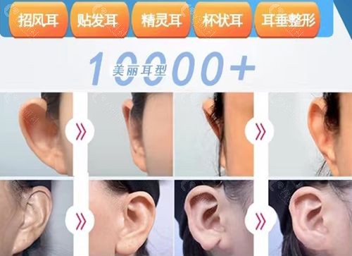 韩国做耳朵整形出名的普罗菲耳医院耳部整形主营项目图片