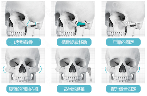 广大医院颧骨整形