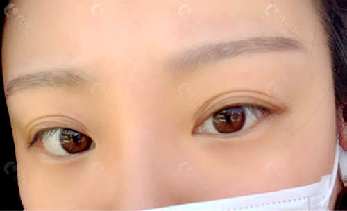 图一：韩国大眼睛双眼皮修复术前
