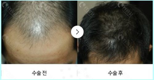 韩国布莱克毛发移植医院男士头顶加密种植前后对比图