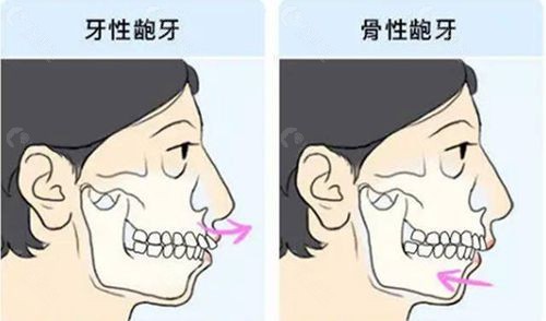 牙性和骨性凸嘴的区别