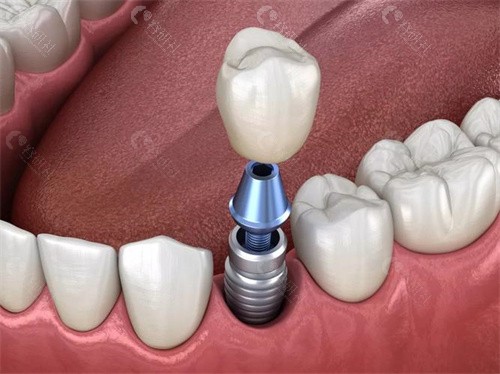 北大口腔医院种植牙哪位医生技术好？