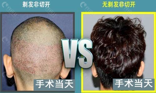 韩国植发和国内植发技术的差别对比