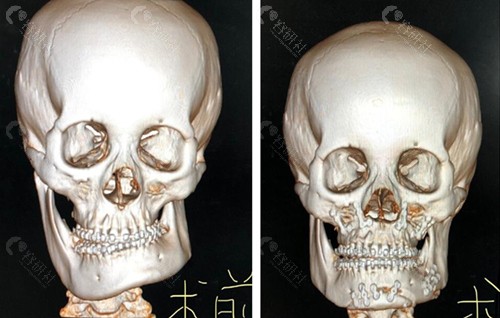 华西医院罗恩医生正颌手术前后对比照