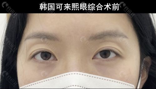 韩国可来熙整形外科眼部整形术前
