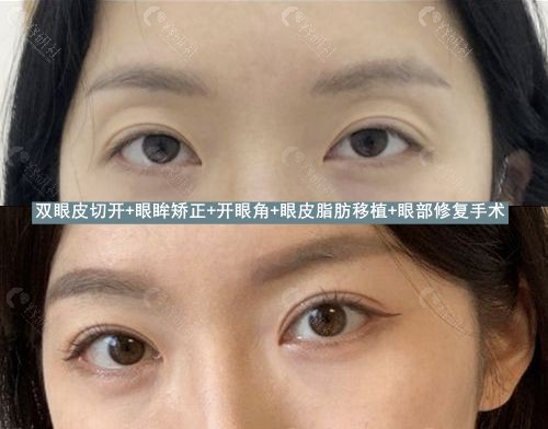 韩国可来熙整形外科眼部整形术前术后对比图