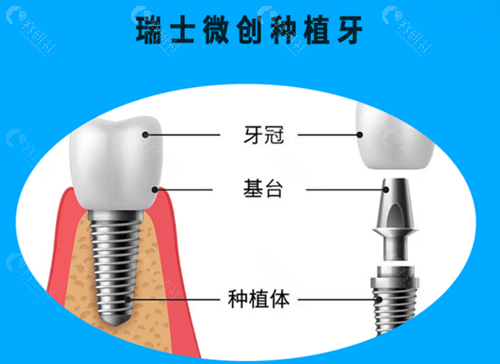 种植牙构造