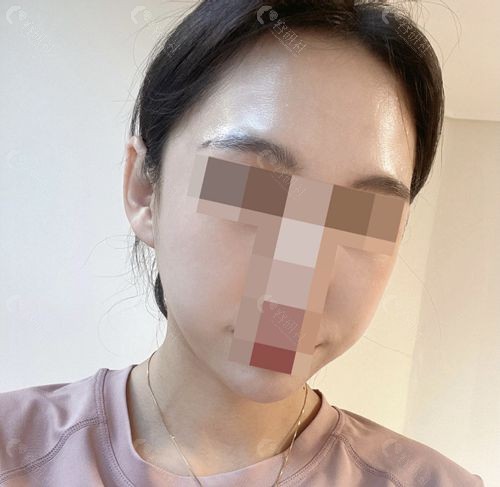 韩国1%整形外科林宗宇院长面部轮廓手术前侧颜照片