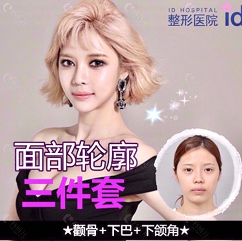 韩国ID整形医院改脸型手术面部轮廓三件套实例