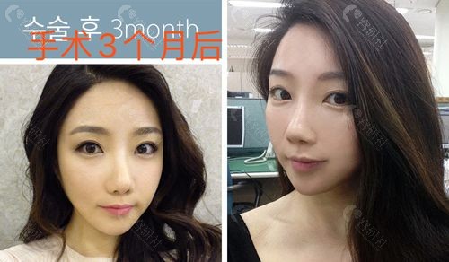 韩国必当归医院面部轮廓+双眼皮手术后3个月