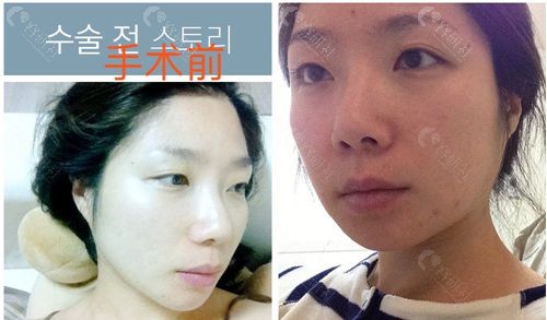 韩国必当归医院面部轮廓+双眼皮手术前照片