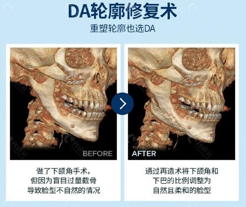 曹栋弼轮廓修复技术优势介绍