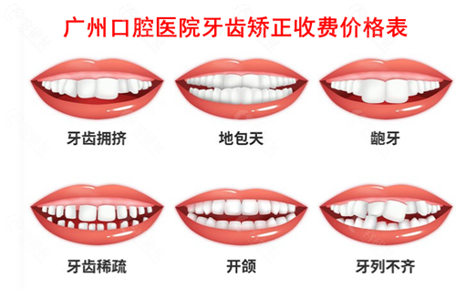 广州口腔医院牙齿矫正收费价格表