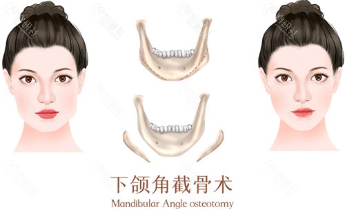 籍建华磨骨有哪些优势？