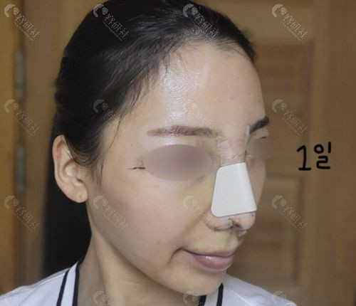 韩国百利酷整形外科鹰钩鼻矫术后即刻照片