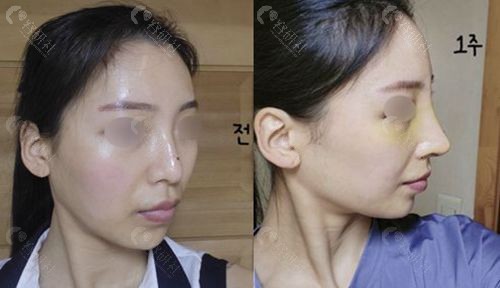 韩国百利酷整形外科鹰钩鼻矫正术前术后对比照