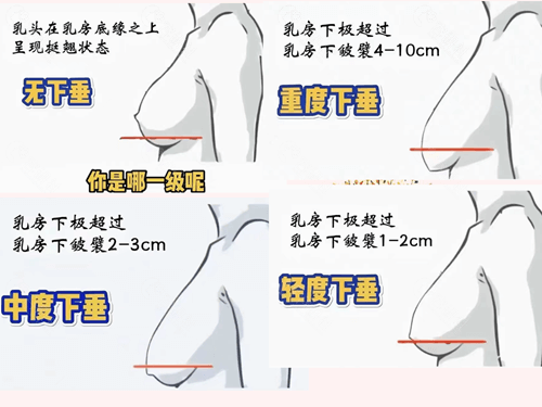 自侧胸部下垂方法及图片。