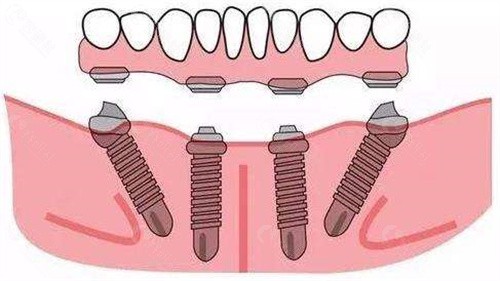 种植全口义齿