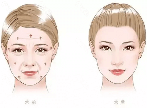面部脂肪填充后脸会变得更容易下垂吗？