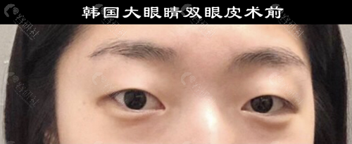 韩国大眼睛整形外科双眼皮术前