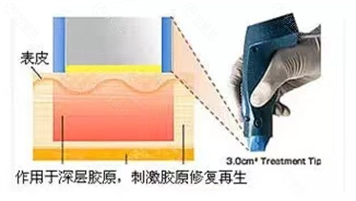 星美极Thermage面部除皱获得国内认证了吗？