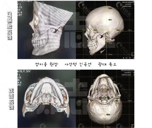 杨君毅磨骨手术对比