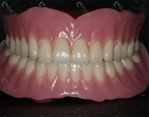 普通全口义齿和吸附性全口义齿有啥区别？普通全口义齿和吸附性全口义齿的区别一览