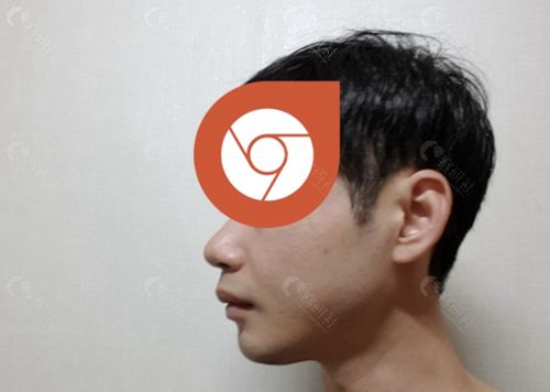 韩国欧佩拉整形外科男士颧骨缩小+方下巴手术后侧面照片