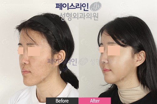 地包天正颌手术前后脸型改变图