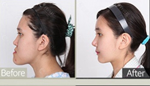 下颌发育过度正颌手术前后脸型改变图