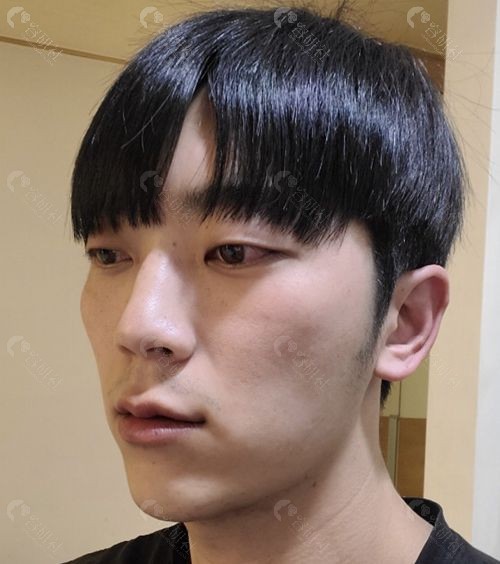 韩国VG百利酷颧骨缩小+鼻子整形术前侧面照片