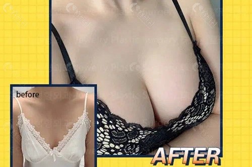 韩国珠儿丽整形外科假体隆胸对比图