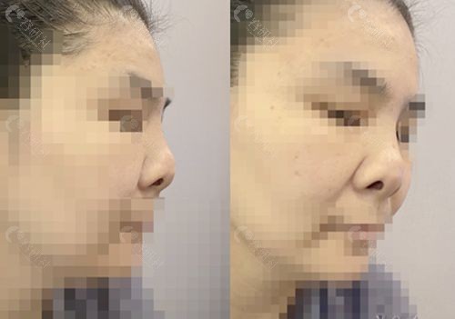 韩国温度整形外科医院高难度挛缩鼻修复手术前照片