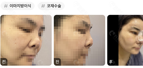 韩国温度整形外科医院高难度挛缩鼻修复恢复过程图
