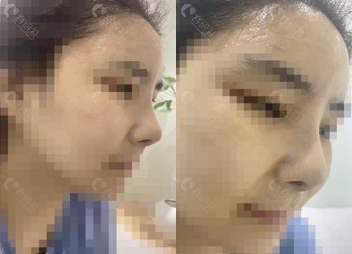 韩国温度整形外科医院高难度挛缩鼻修复术后照片