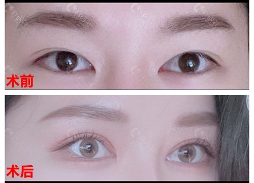 韩国爱护整形医院双眼皮+开眼角手术对比照片