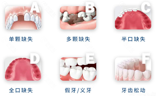 需要做种植牙的情况