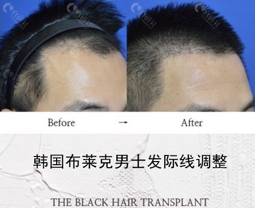 韩国布莱克毛发移植中心男性毛发移植