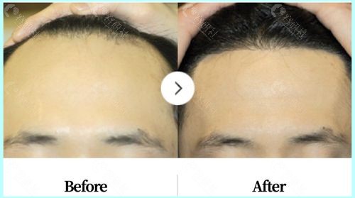 韩国布莱克毛发移植中心发际线种植图片