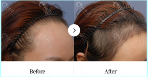 韩国布莱克毛发移植中心女士发际线移植前后对比图