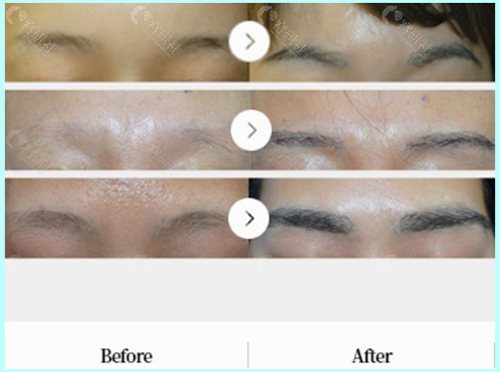 韩国布莱克毛发移植医院植眉前后对比图