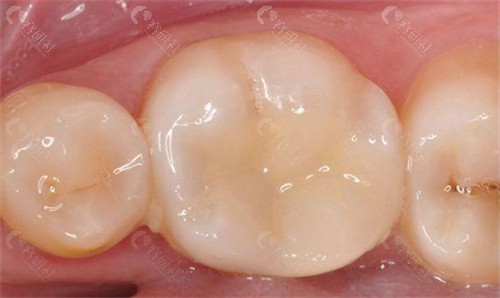 柳州口腔医院补牙价格表拔智齿阻生:880元起拔智齿普通:580元起乳牙