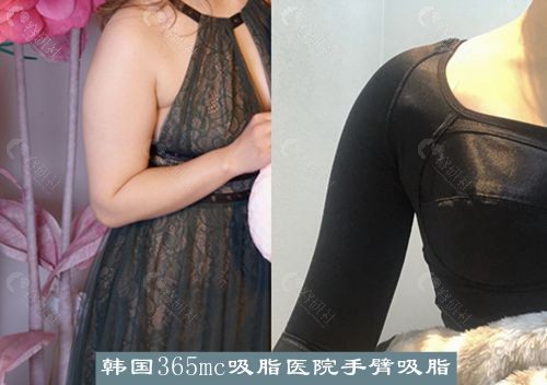 韩国365mc吸脂医院手臂吸脂术前术后对比图