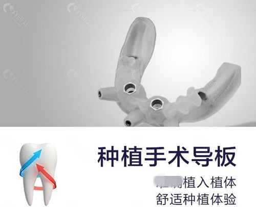 种植牙导板技术