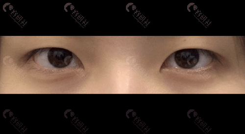 韩国爱护整形外科双眼皮术前