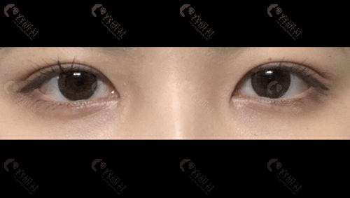 韩国爱护做双眼皮术后一个月